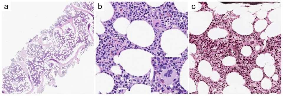 Fig.1 Examples of histological features of myeloid proliferation and neoplasm diseases.