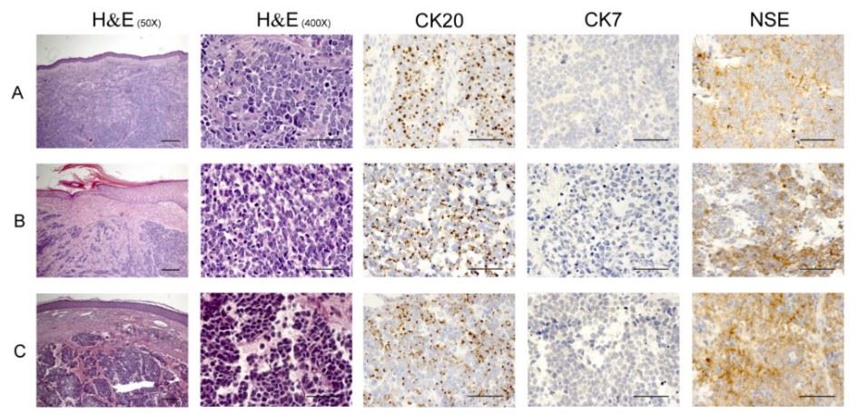 Immunohistological analysis of Merkel cell carcinoma (MCC).