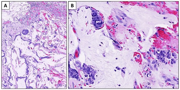 Histomorphology of the lesion.