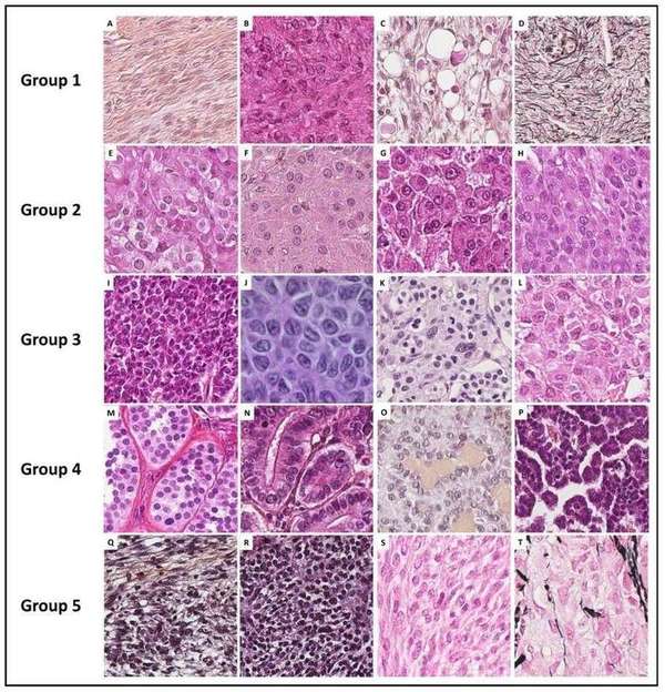 Histopathological illustrations of ovarian sex cord–stromal tumors classified into 5 Groups according to predominant cell morphology.