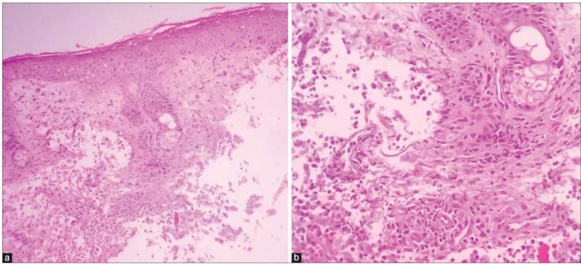 Histopathology of individuals with tinea barbae.