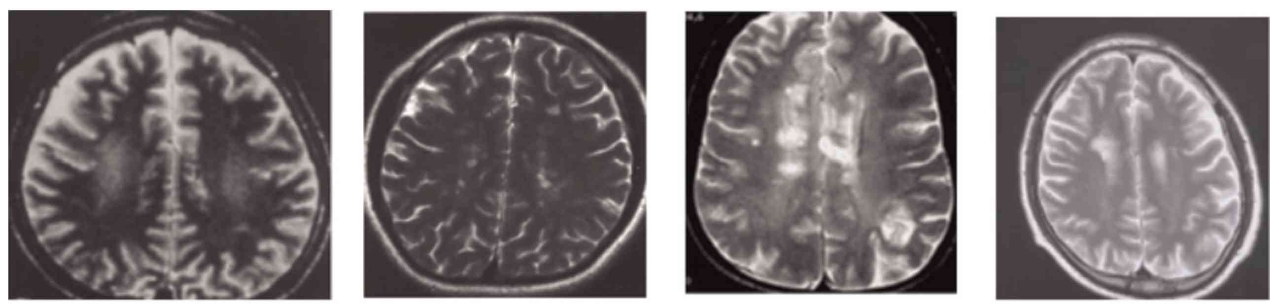 MRI results of FFI individual.