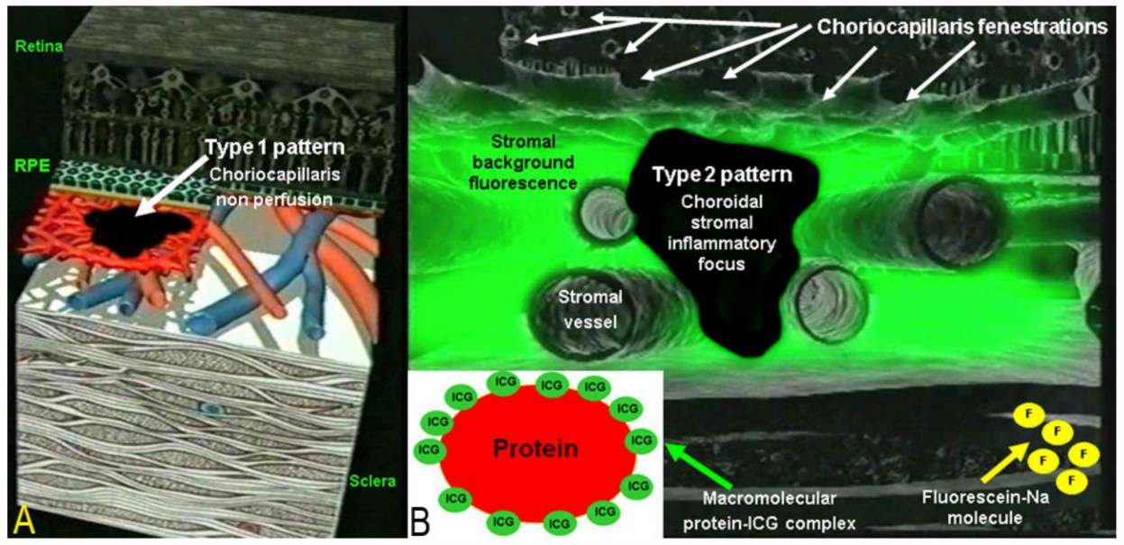 Indocyanine green angiography (ICGA) patterns in noninfectious choroiditis.
