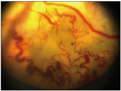Retinal features of Coats disease.