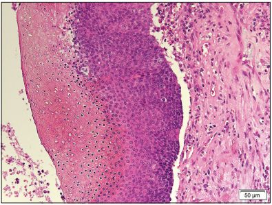 Histopathological analysis of Eyelid Pilomatrixoma.