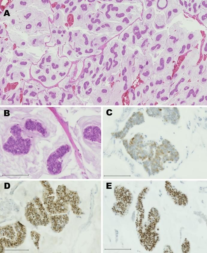 A case of histopathological analysis of a metastatic orbital tumor.