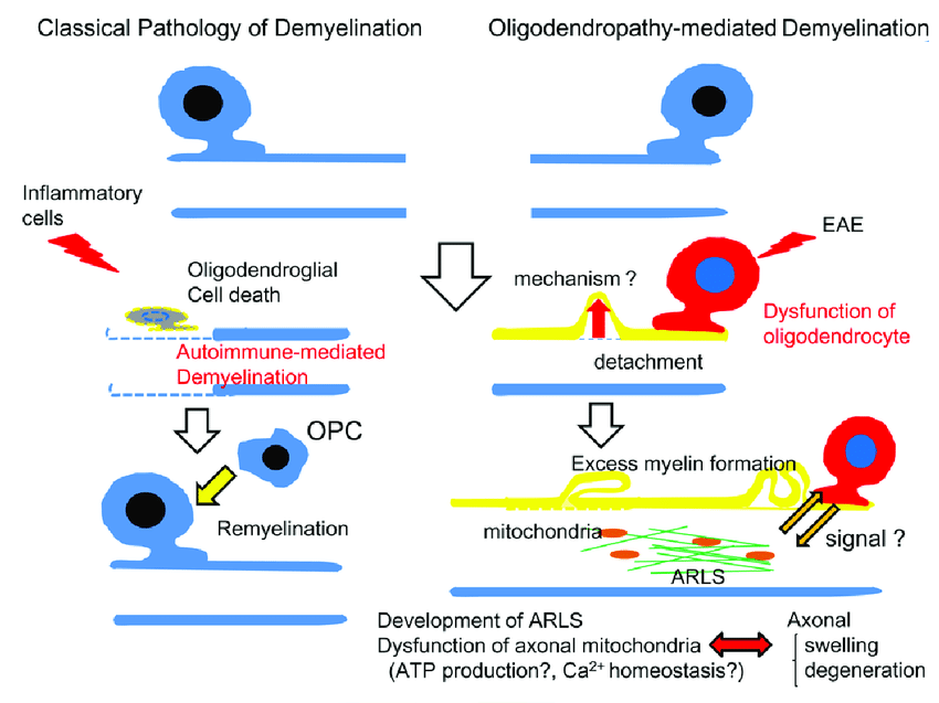 Fig. 1 Schematic mechanisms of demyelination.